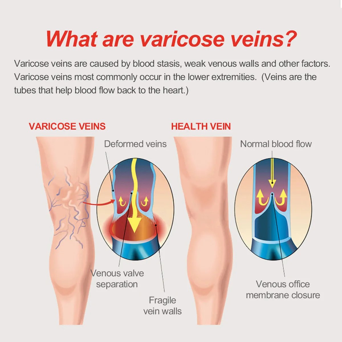 Varicose Veins Patch