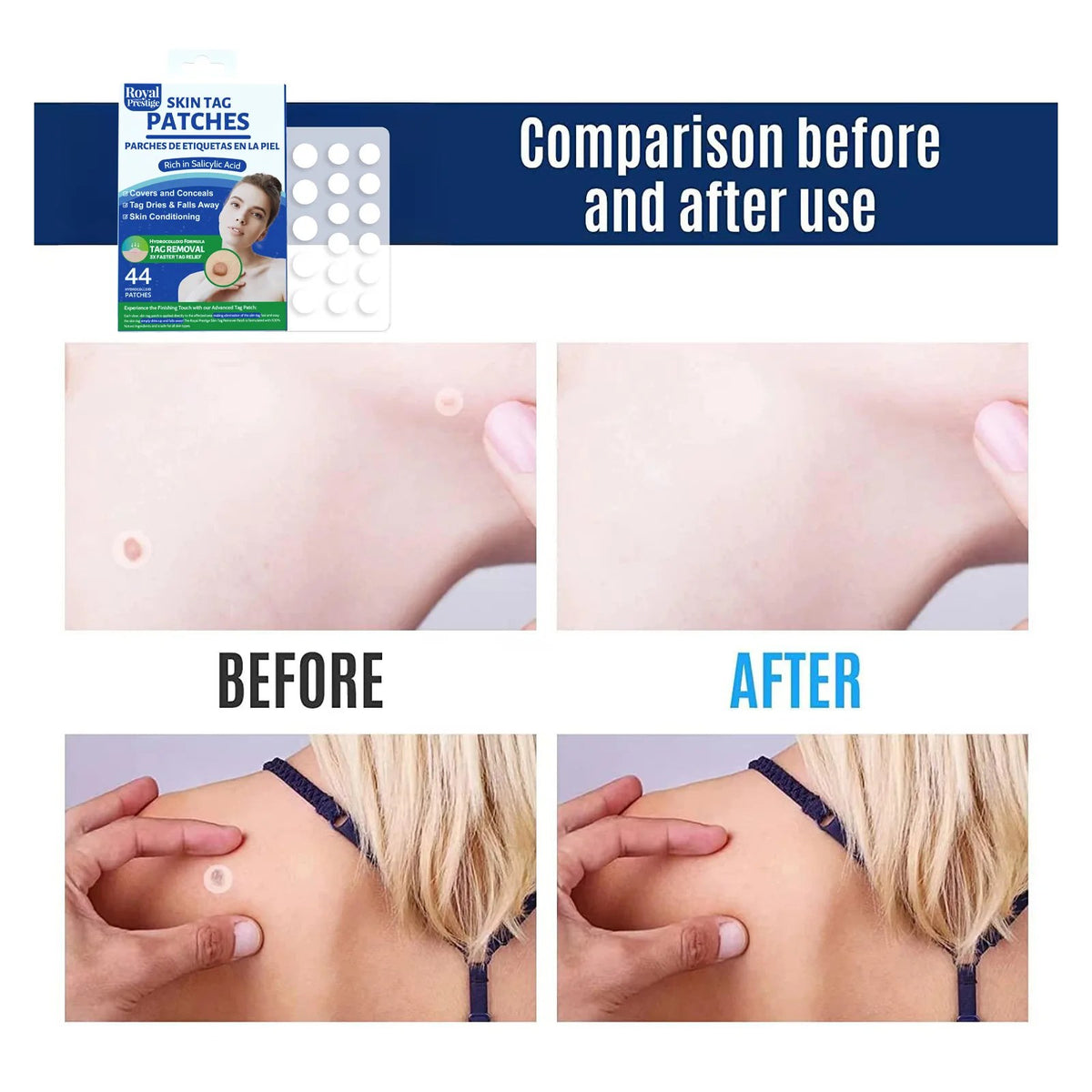 Skin Tag Remover Patches 44 PCs by Royal Prestige
