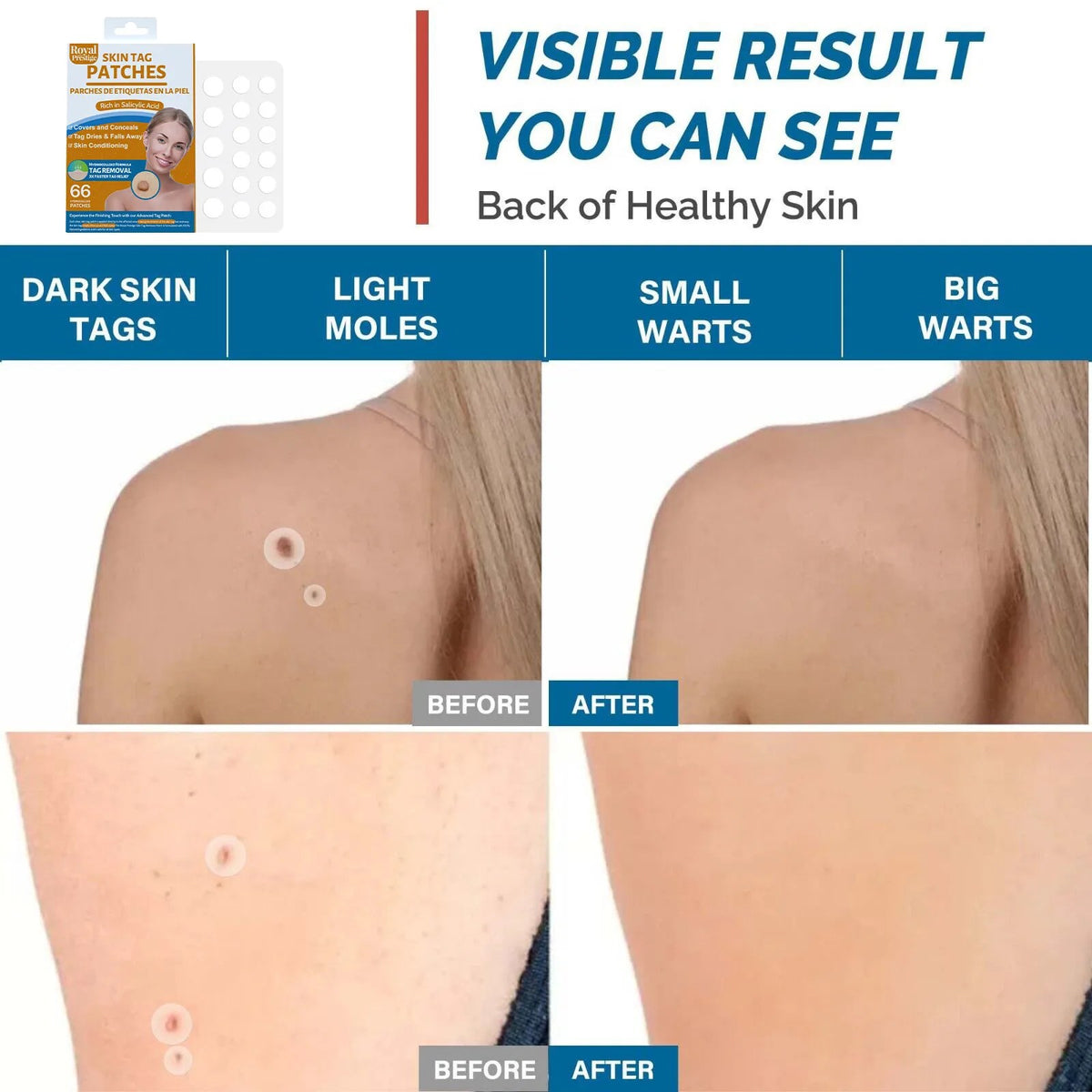 Skin Tag Remover Patches, 66 Patches by Royal Prestige