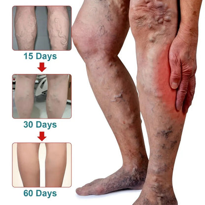 Varicose Vein Care Patch (1 Box) – Herbal Leg Support Patch for Circulation & Vein Comfort